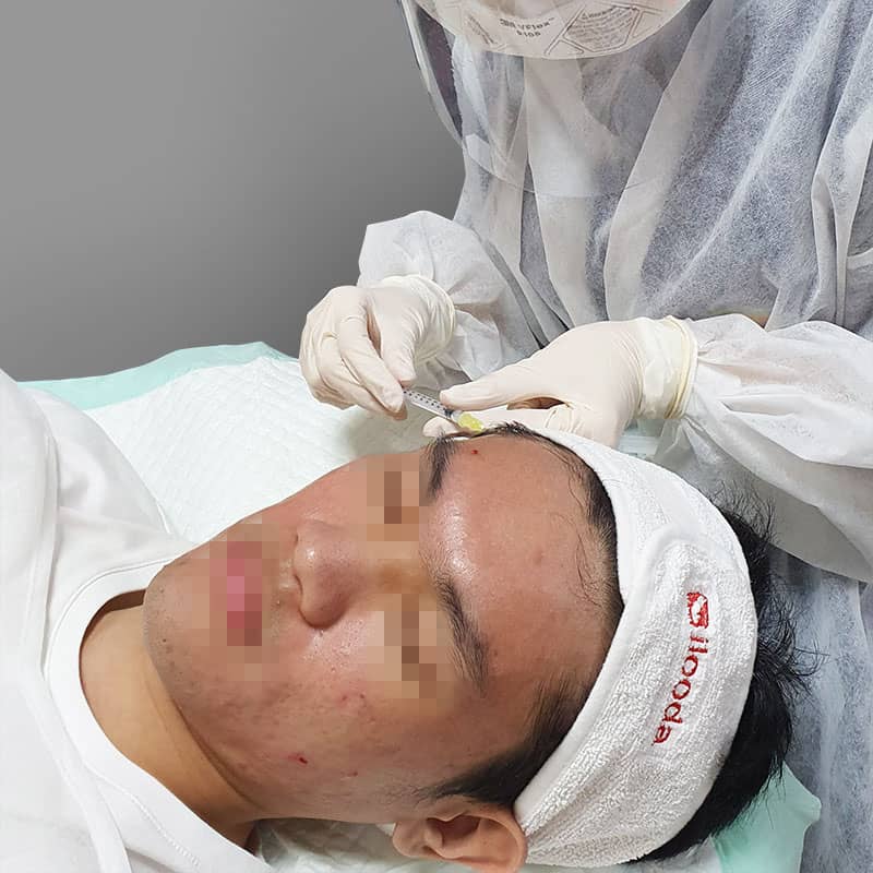 Acne Institute Rapid Injection