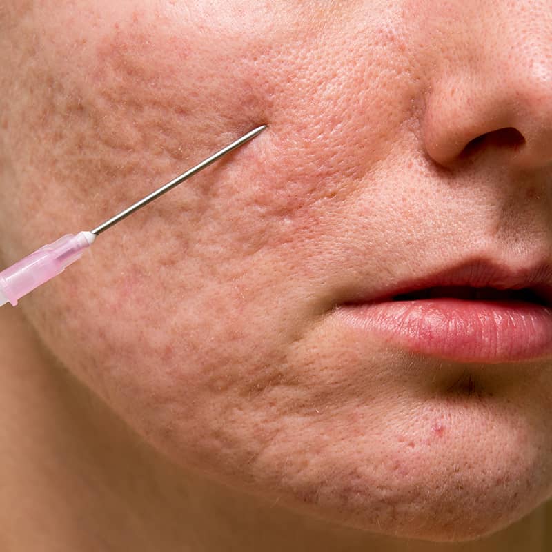 Scar Cure for Acne Scar Revision