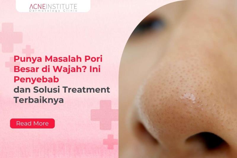 Punya Masalah Pori Besar di Wajah? Ini Penyebab dan Solusi Treatment Terbaiknya