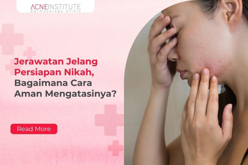 Jerawatan Jelang Persiapan Nikah, Bagaimana Cara Aman Mengatasinya?