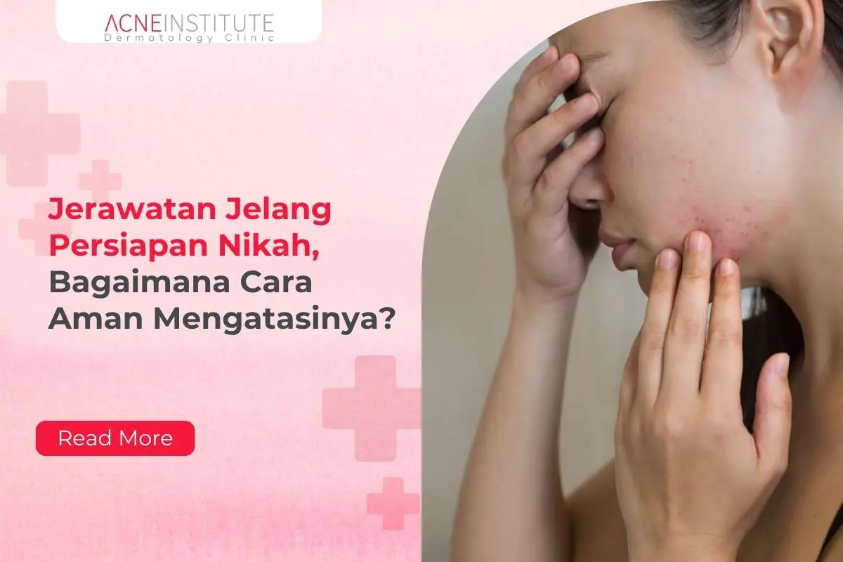 Jerawatan Jelang Persiapan Nikah, Bagaimana Cara Aman Mengatasinya?