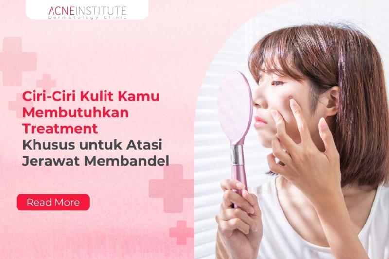 Ciri-Ciri Kulit Kamu Membutuhkan Treatment Khusus untuk Atasi Jerawat Membandel