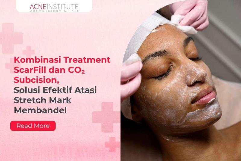 Kombinasi Treatment ScarFill dan CO2 Subcision, Solusi Efektif Atasi Stretch Mark Membandel