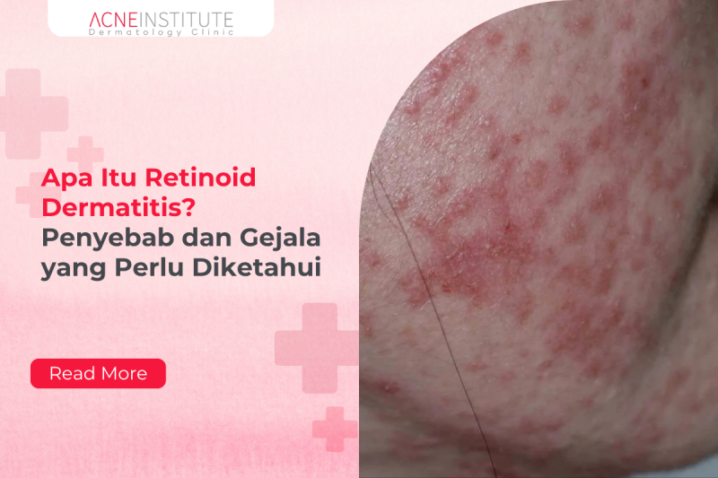Apa Itu Retinoid Dermatitis? Penyebab dan Gejala yang Perlu Diketahui