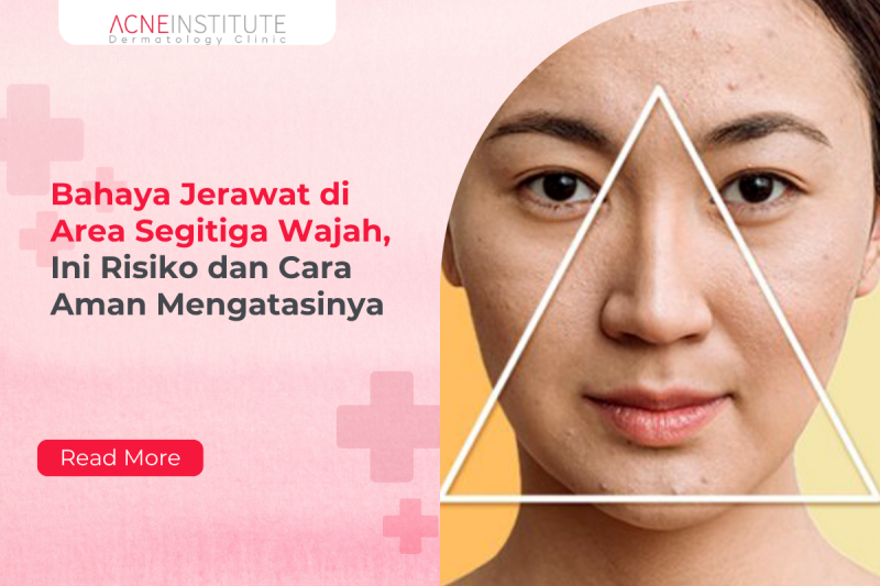 Bahaya Jerawat di Area Segitiga Wajah, Ini Risiko dan Cara Aman Mengatasinya