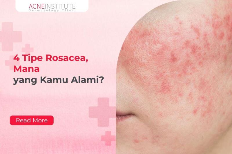 4 Tipe Rosacea, Mana yang Kamu Alami?