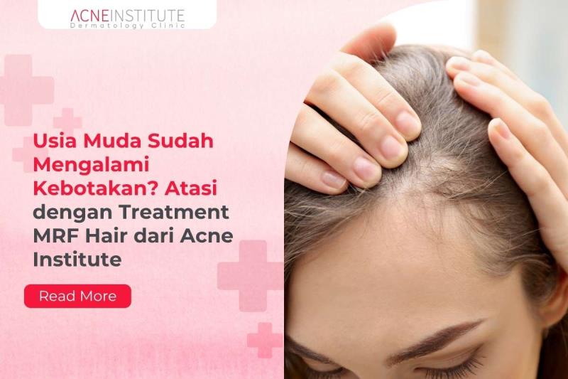 Usia Muda Sudah Mengalami Kebotakan? Atasi dengan Treatment MRF Hair dari Acne Institute