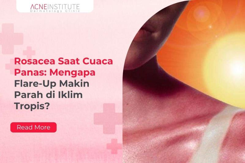 Rosacea Saat Cuaca Panas: Mengapa Flare-Up Makin Parah di Iklim Tropis?