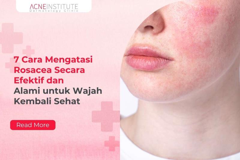 7 Cara Mengatasi Rosacea Secara Efektif dan Alami untuk Wajah Kembali Sehat