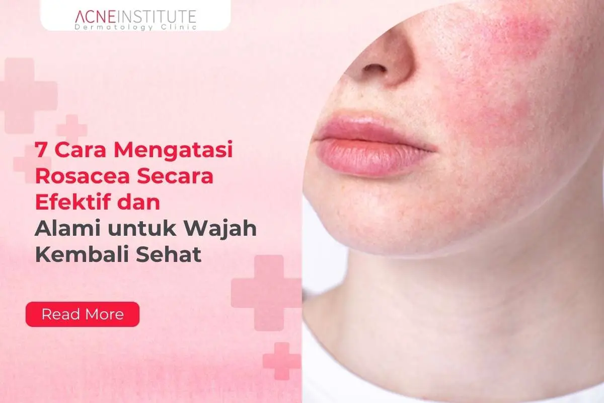 7 Cara Mengatasi Rosacea Secara Efektif dan Alami untuk Wajah Kembali Sehat
