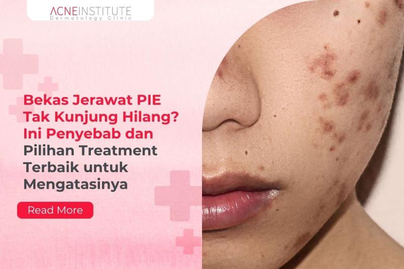 Bekas Jerawat PIE Tak Kunjung Hilang? Ini Penyebab dan Pilihan Treatment Terbaik untuk Mengatasinya