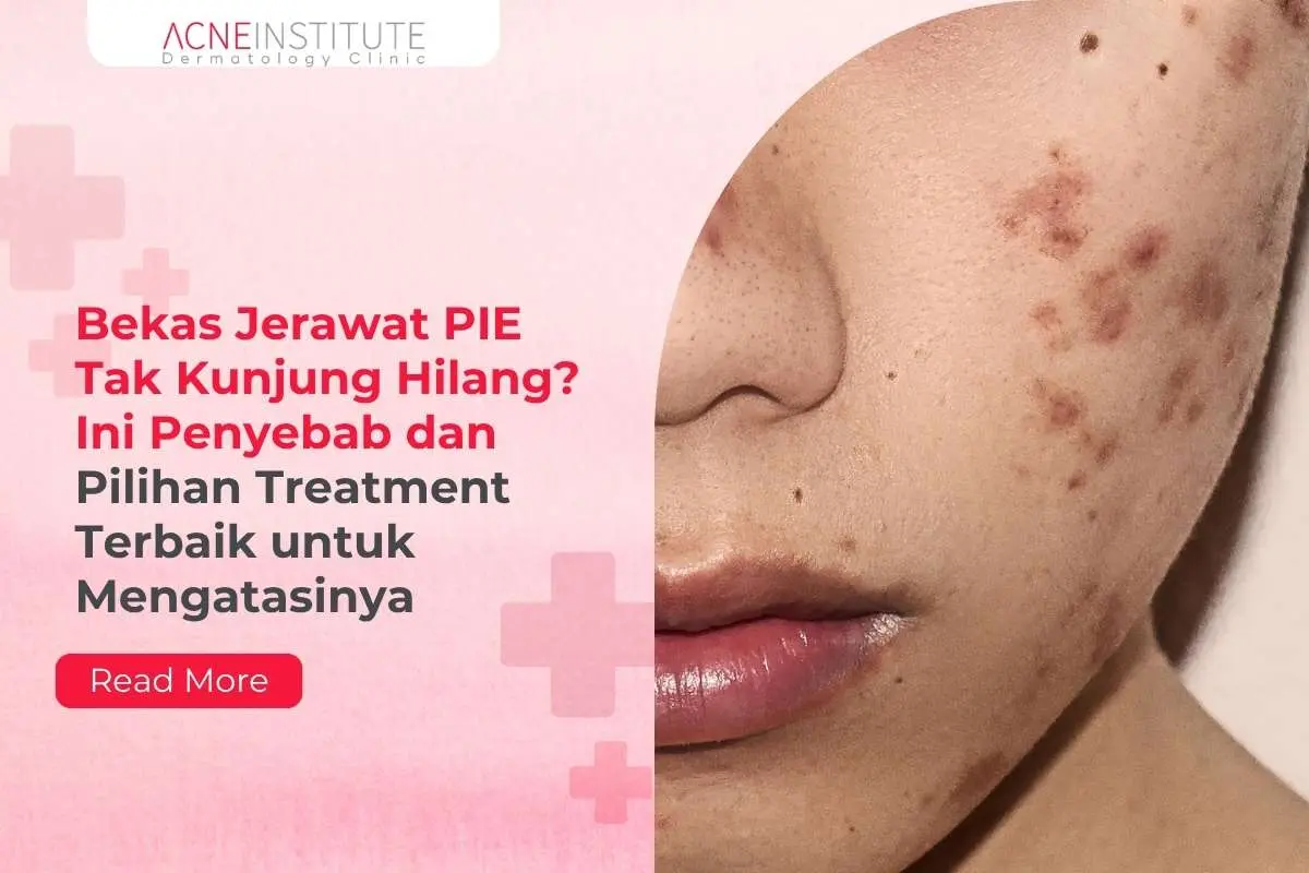Bekas Jerawat PIE Tak Kunjung Hilang? Ini Penyebab dan Pilihan Treatment Terbaik untuk Mengatasinya