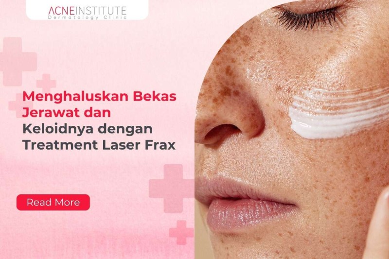 Menghaluskan Bekas Jerawat dan Keloidnya dengan Treatment Laser Frax