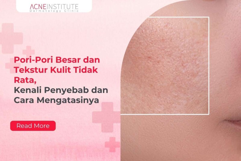 Pori-Pori Besar dan Tekstur Kulit Tidak Rata, Kenali Penyebab dan Cara Mengatasinya
