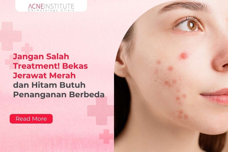 Jangan Salah Treatment! Bekas Jerawat Merah dan Hitam Butuh Penanganan Berbeda