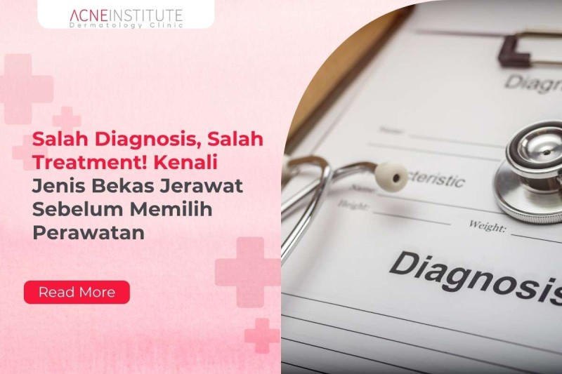 Salah Diagnosis, Salah Treatment! Kenali Jenis Bekas Jerawat Sebelum Memilih Perawatan