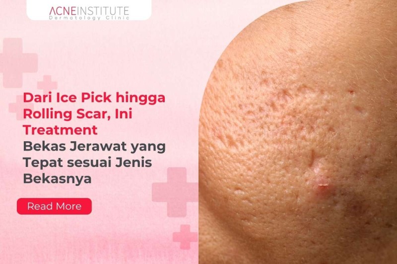 Dari Ice Pick hingga Rolling Scar, Ini Treatment Bekas Jerawat yang Tepat sesuai Jenis Bekasnya