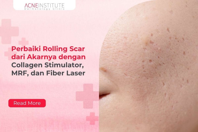 Perbaiki Rolling Scar dari Akarnya dengan Collagen Stimulator, MRF, dan Fiber Laser