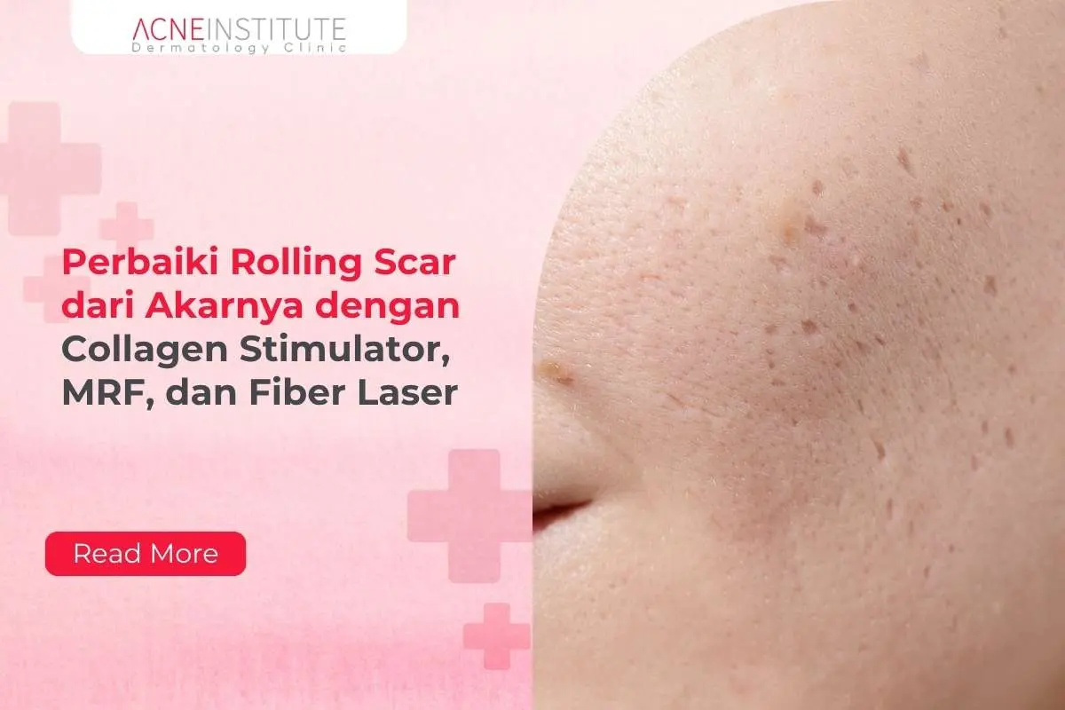 Perbaiki Rolling Scar dari Akarnya dengan Collagen Stimulator, MRF, dan Fiber Laser