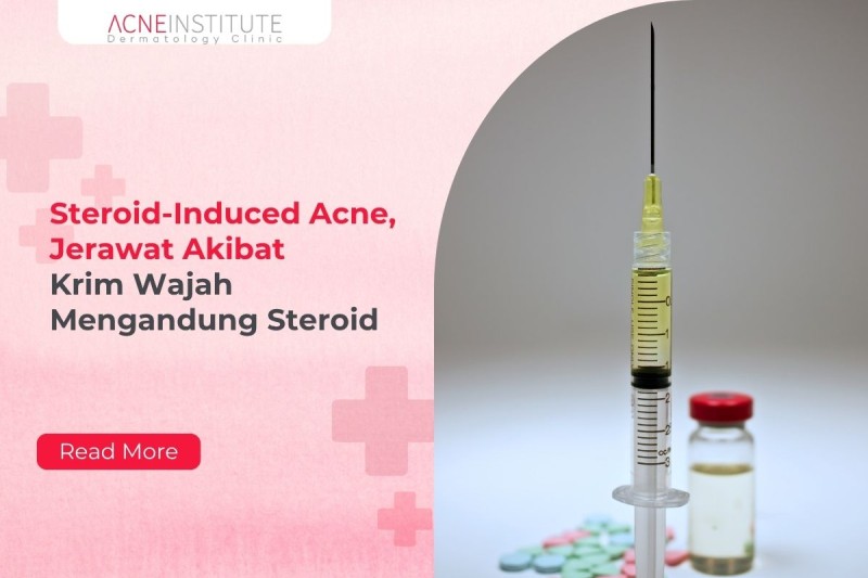 Steroid-Induced Acne, Jerawat Akibat Krim Wajah Mengandung Steroid