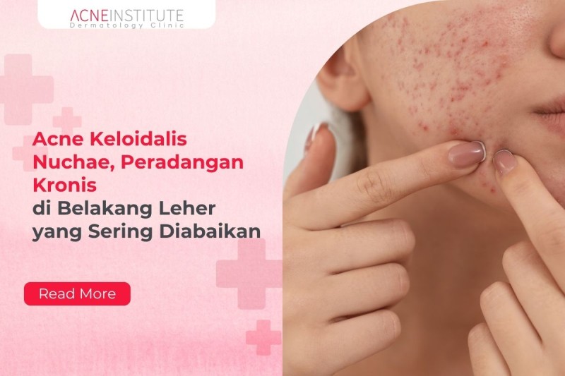 Acne Keloidalis Nuchae, Peradangan Kronis di Belakang Leher yang Sering Diabaikan