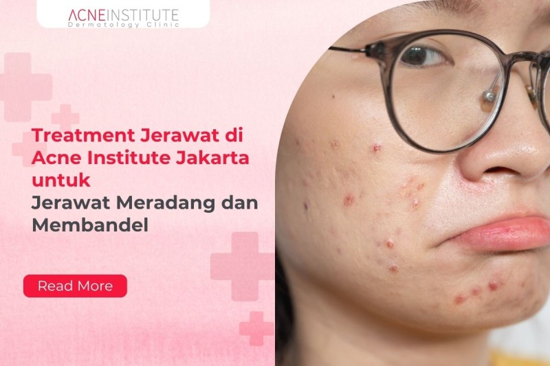 Treatment Jerawat di Acne Institute Jakarta untuk Jerawat Meradang dan Membandel