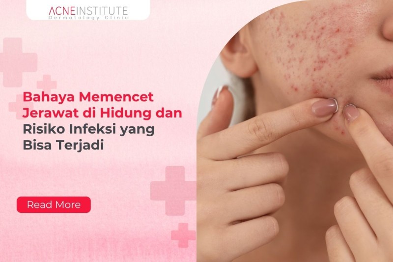 Bahaya Memencet Jerawat di Hidung dan Risiko Infeksi yang Bisa Terjadi