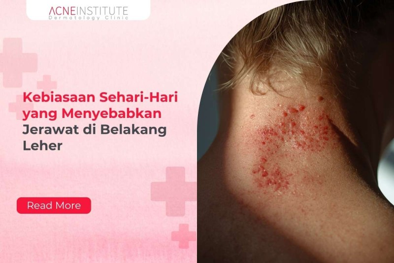 Kebiasaan Sehari-Hari yang Menyebabkan Jerawat di Belakang Leher