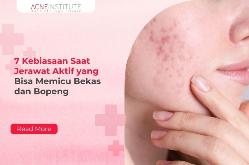 7 Kebiasaan Saat Jerawat Aktif yang Bisa Memicu Bekas dan Bopeng