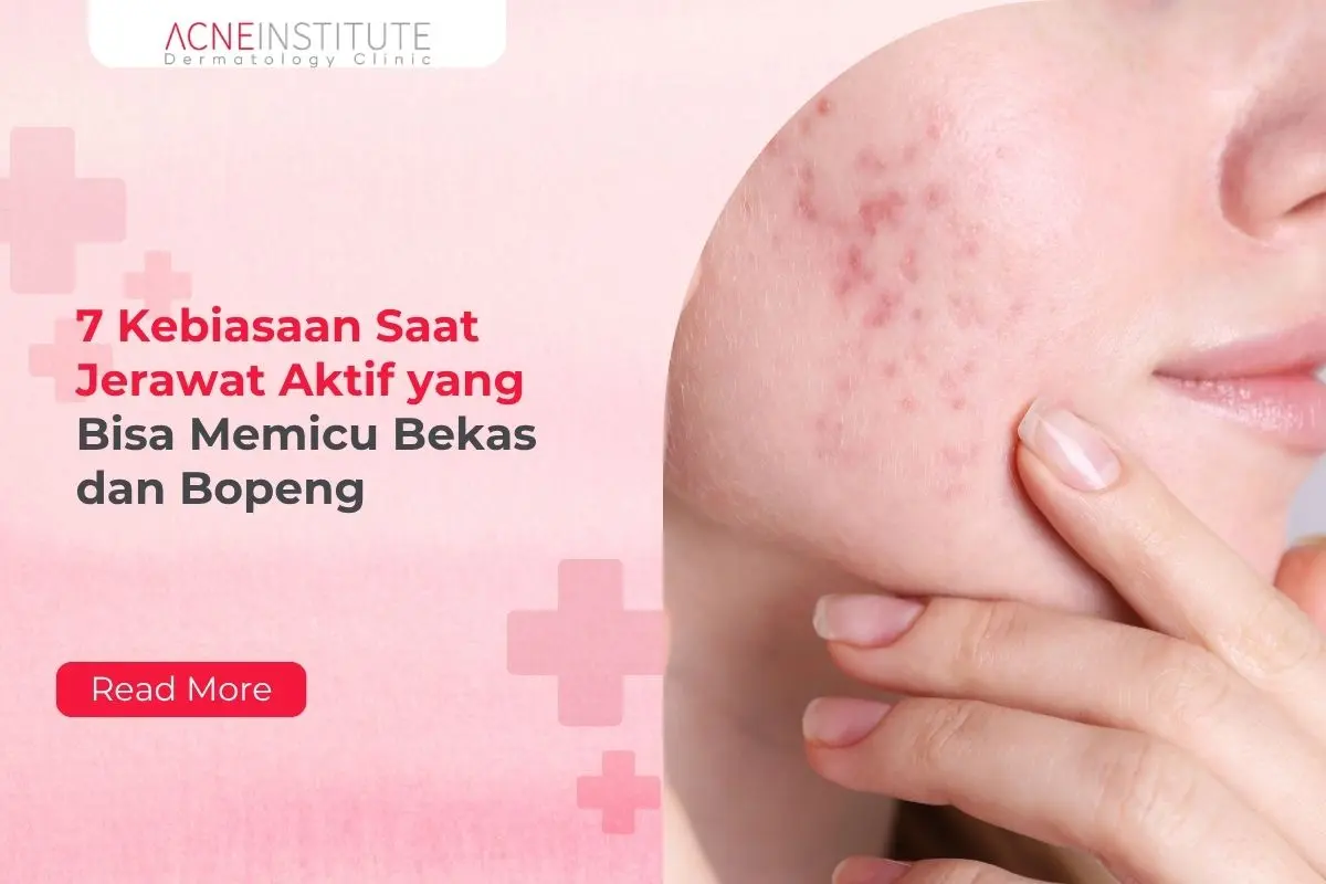 7 Kebiasaan Saat Jerawat Aktif yang Bisa Memicu Bekas dan Bopeng