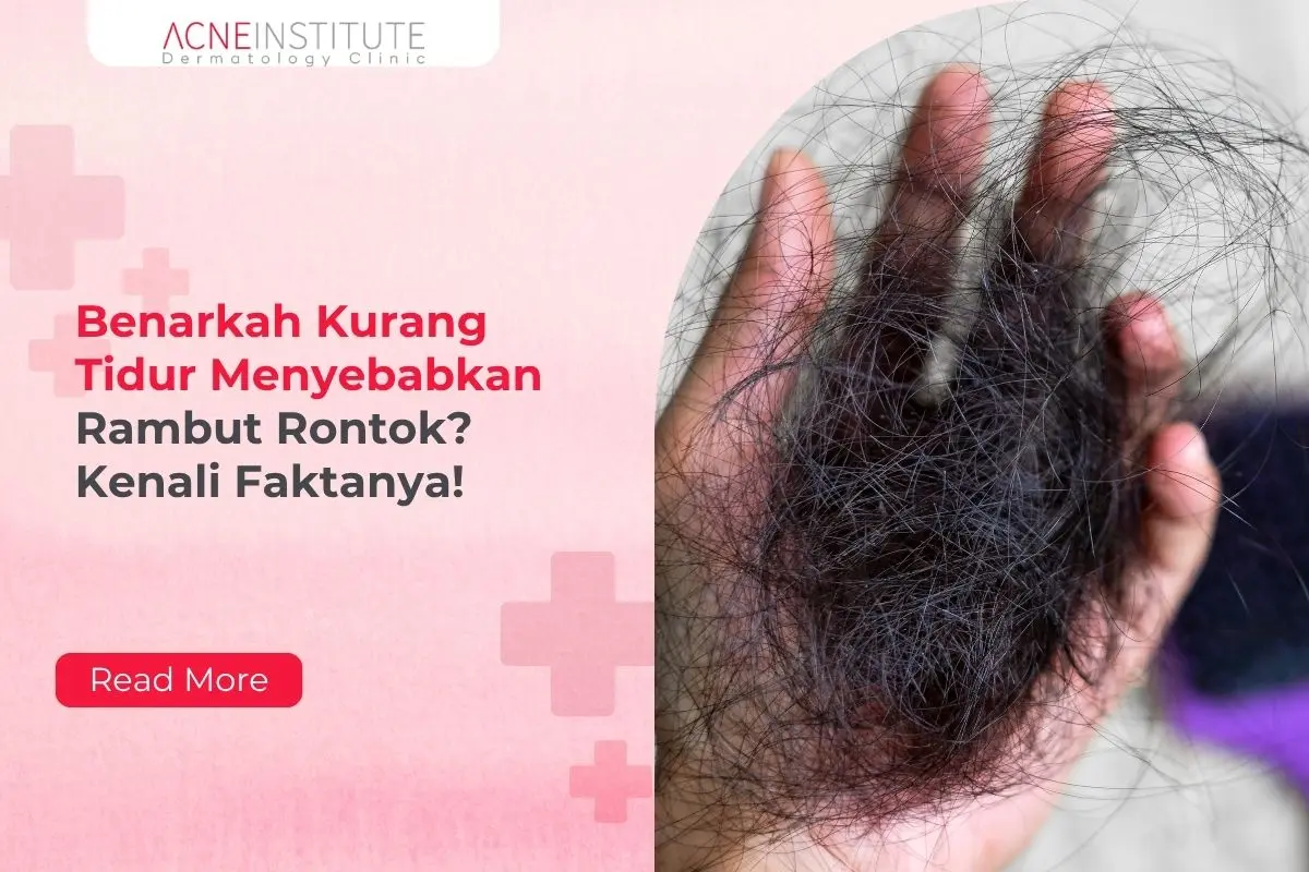 Benarkah Kurang Tidur Menyebabkan Rambut Rontok? Kenali Faktanya!