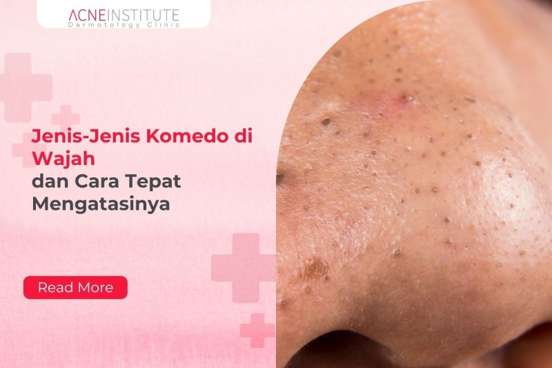 Jenis-Jenis Komedo di Wajah dan Cara Tepat Mengatasinya