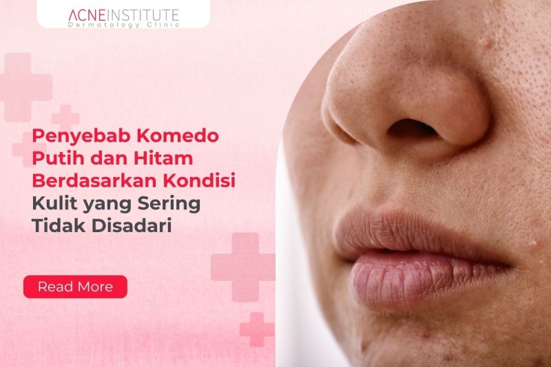 Penyebab Komedo Putih dan Hitam Berdasarkan Kondisi Kulit yang Sering Tidak Disadari