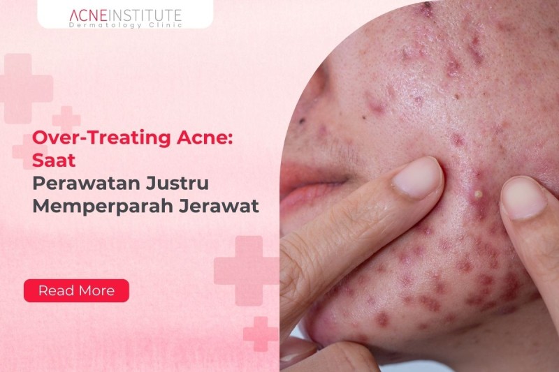 Over-Treating Acne: Saat Perawatan Justru Memperparah Jerawat