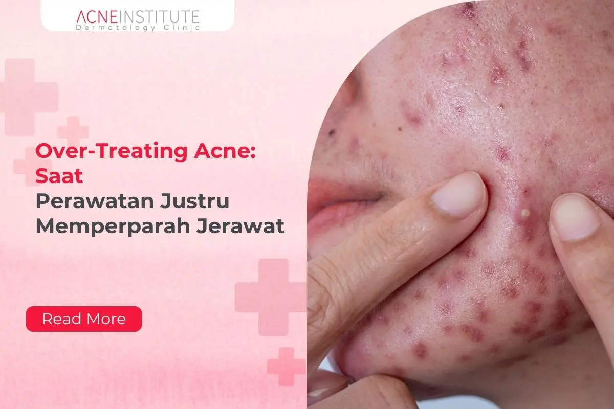 Over-Treating Acne: Saat Perawatan Justru Memperparah Jerawat