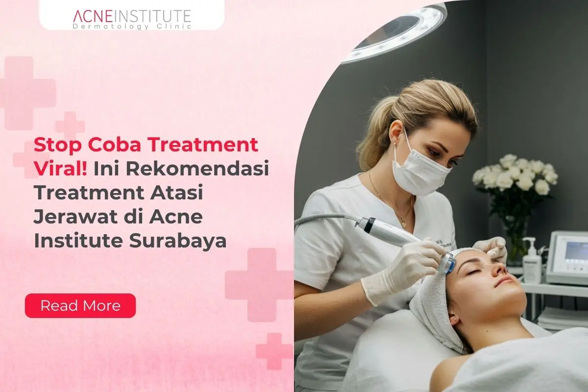 Stop Coba Treatment Viral! Ini Rekomendasi Treatment Atasi Jerawat di Acne Institute Surabaya