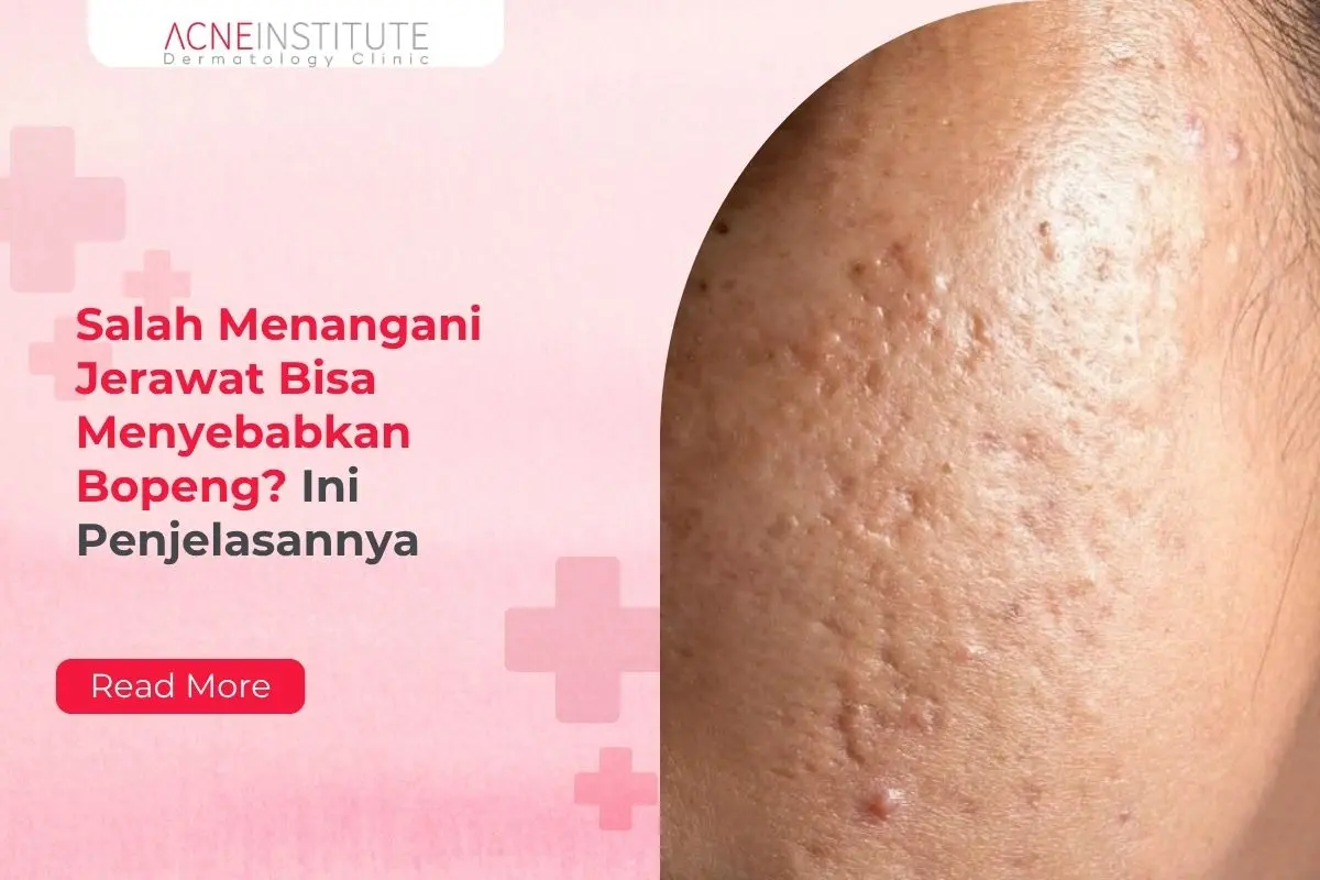 Salah Menangani Jerawat Bisa Menyebabkan Bopeng? Ini Penjelasannya