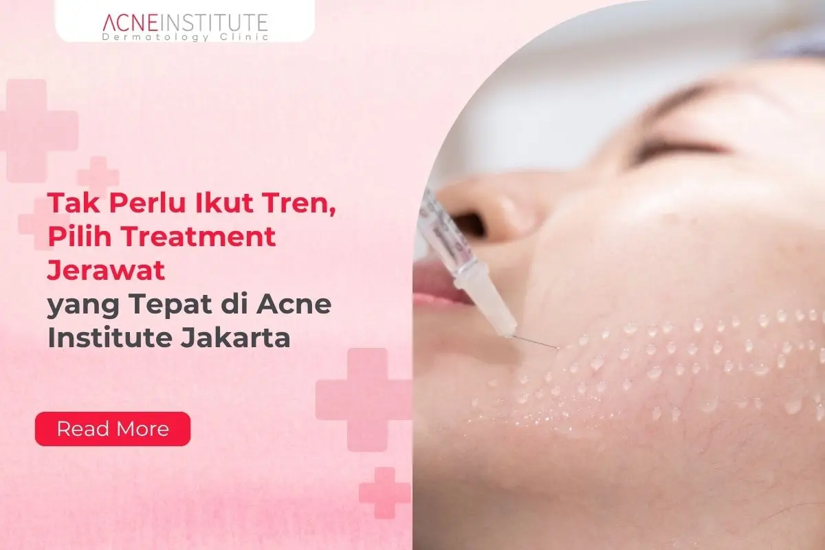 Tak Perlu Ikut Tren, Pilih Treatment Jerawat yang Tepat di Acne Institute Jakarta