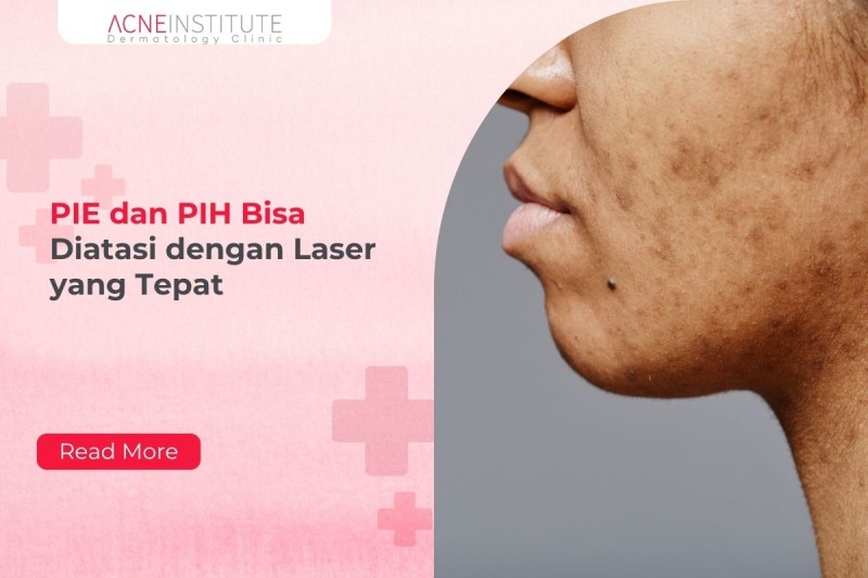 PIE dan PIH Bisa Diatasi dengan Laser yang Tepat