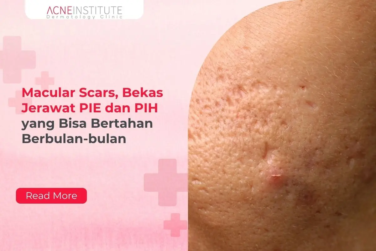 Macular Scars, Bekas Jerawat PIE dan PIH yang Bisa Bertahan Berbulan-bulan