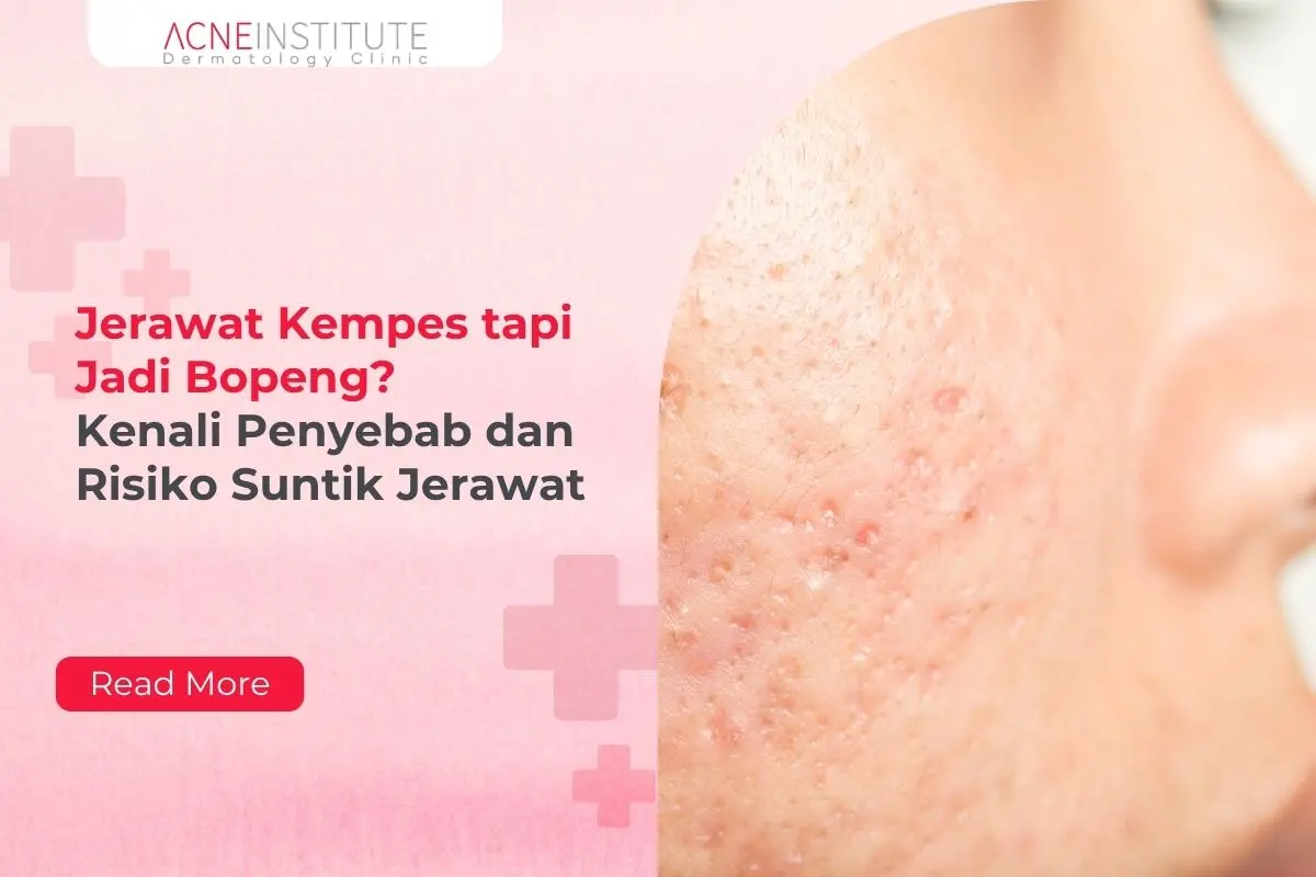 Jerawat Kempes tapi Jadi Bopeng? Kenali Penyebab dan Risiko Suntik Jerawat