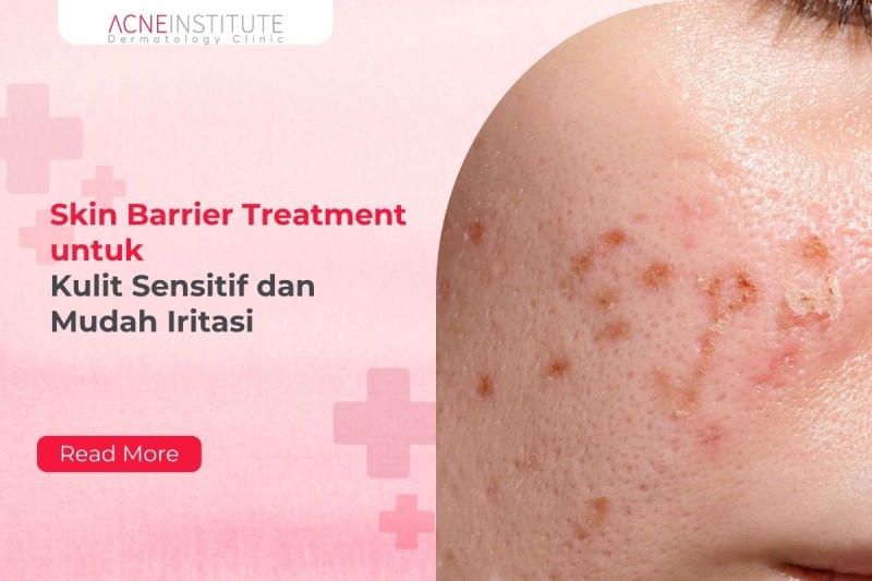 Skin Barrier Treatment untuk Kulit Sensitif dan Mudah Iritasi