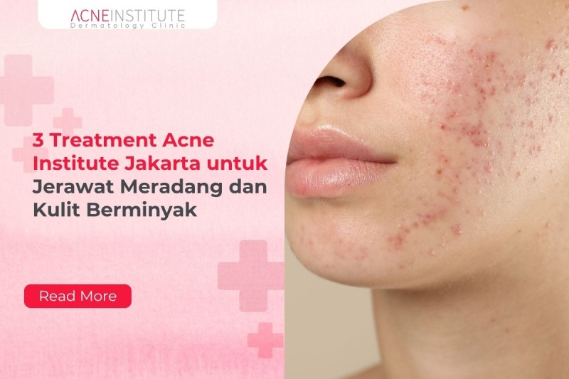 3 Treatment Acne Institute Jakarta untuk Jerawat Meradang dan Kulit Berminyak