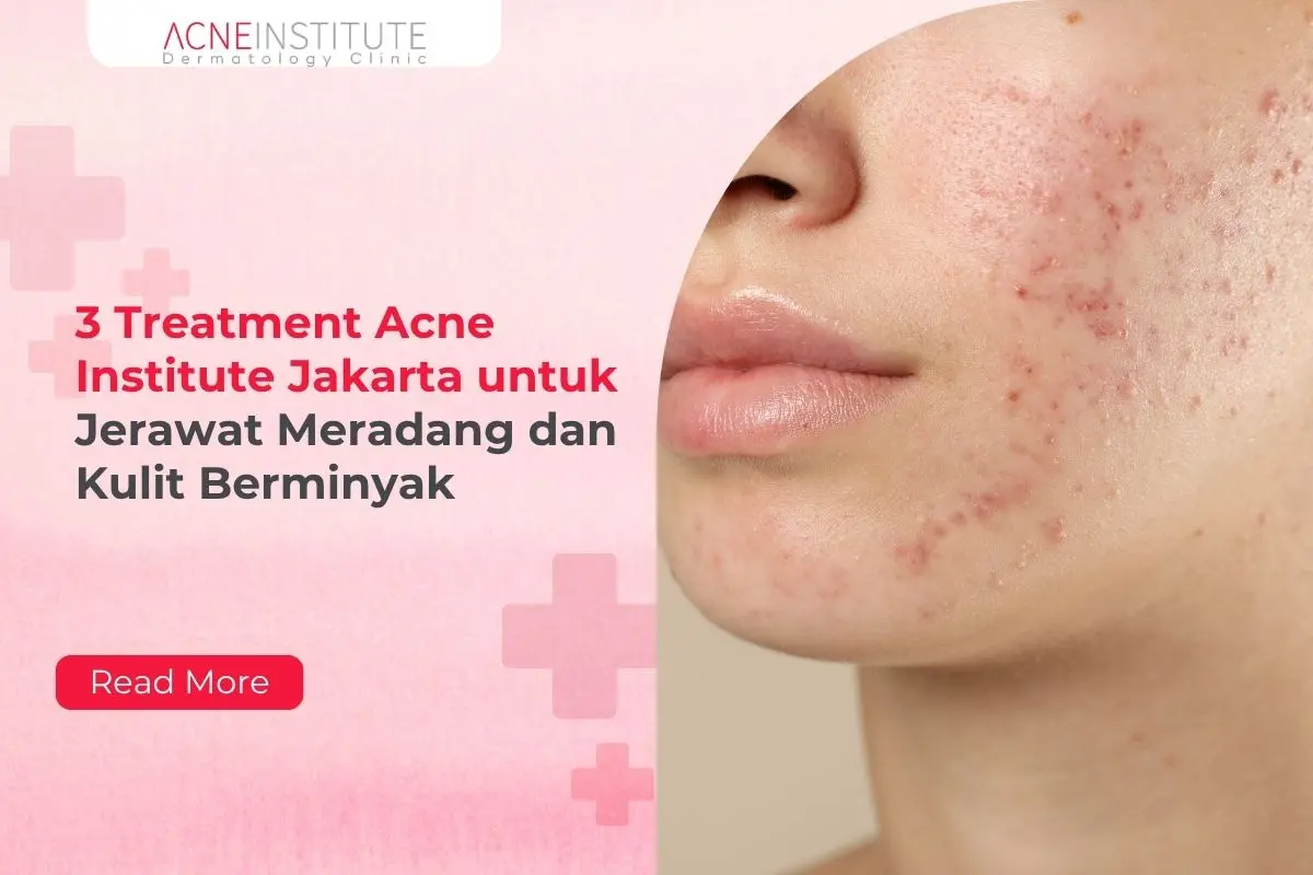 3 Treatment Acne Institute Jakarta untuk Jerawat Meradang dan Kulit Berminyak