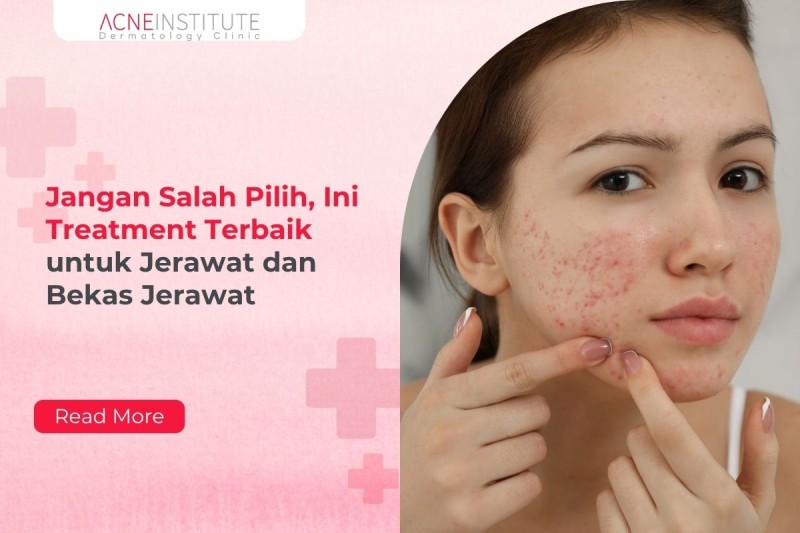 Jangan Salah Pilih, Ini Treatment Terbaik untuk Jerawat dan Bekas Jerawat
