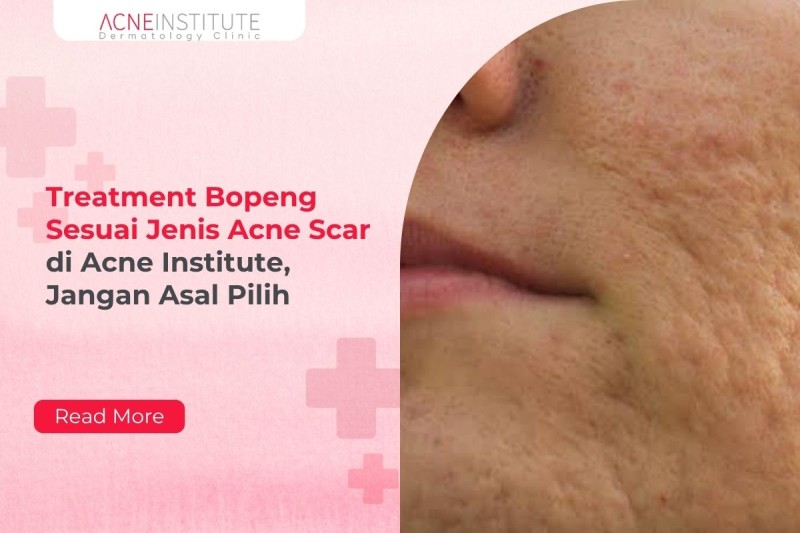 Treatment Bopeng Sesuai Jenis Acne Scar di Acne Institute, Jangan Asal Pilih