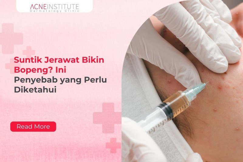 Suntik Jerawat Bikin Bopeng? Ini Penyebab yang Perlu Diketahui