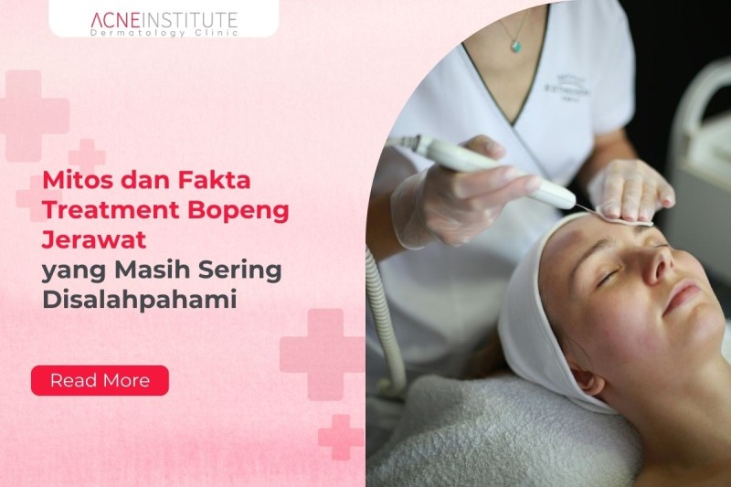 Mitos dan Fakta Treatment Bopeng Jerawat yang Masih Sering Disalahpahami