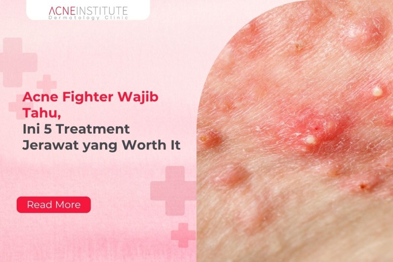 Acne Fighter Wajib Tahu, Ini 5 Treatment Jerawat yang Worth It