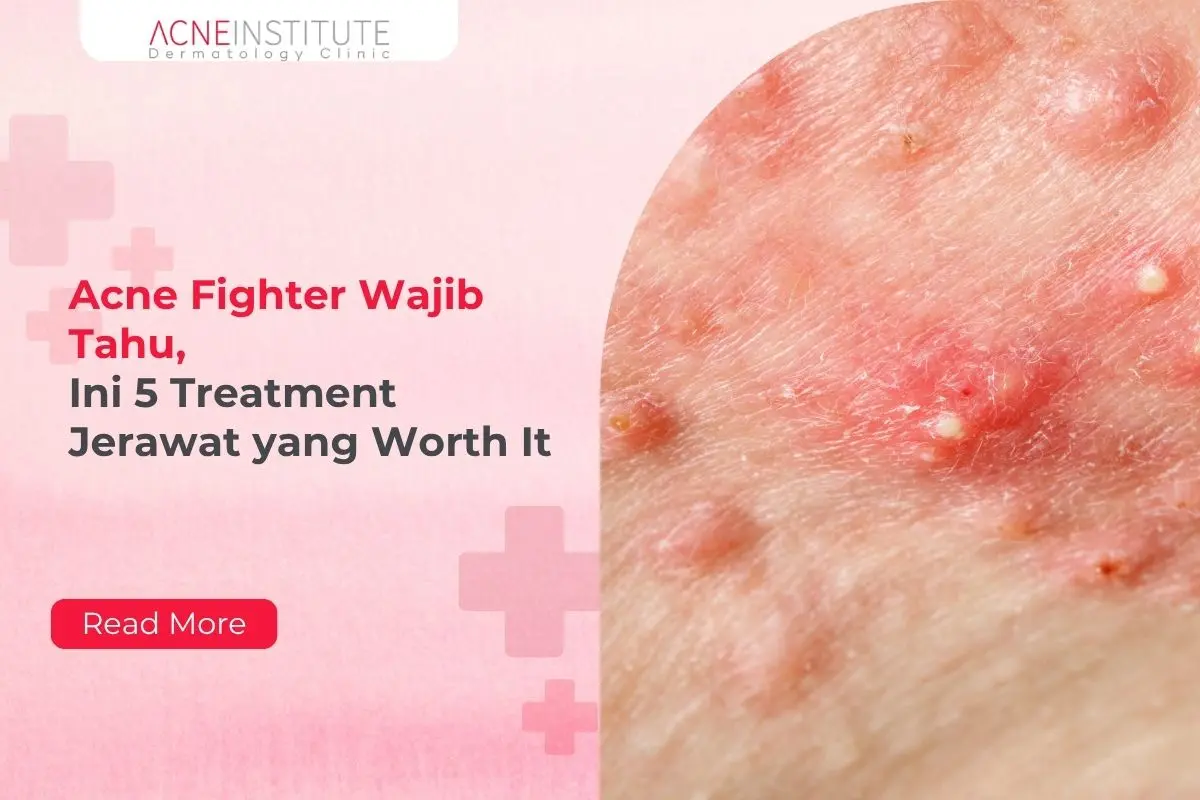 Acne Fighter Wajib Tahu, Ini 5 Treatment Jerawat yang Worth It